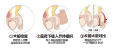 第二代脫細胞生物(wù)補片技(jì )術 —— 治療早洩 立竿