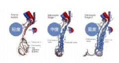 精(jīng)索靜脈曲張微創手術—— 一次性治療精(jīng)索靜脈
