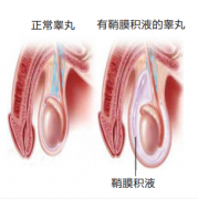 腹腔鏡鞘膜積液微創修複手術——有(yǒu)效治療鞘膜